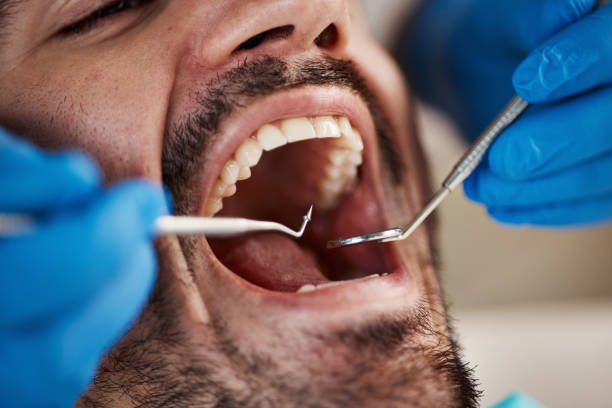 Dental Inlays and Onlays in Cleveland, AL